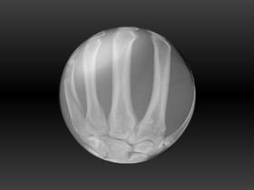 Global Metacarpals
